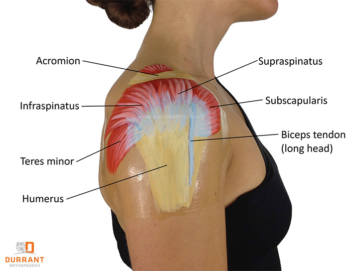 illustration of rotator cuff tear