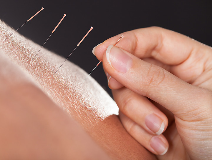 an individual getting acupucture treatment for back pain