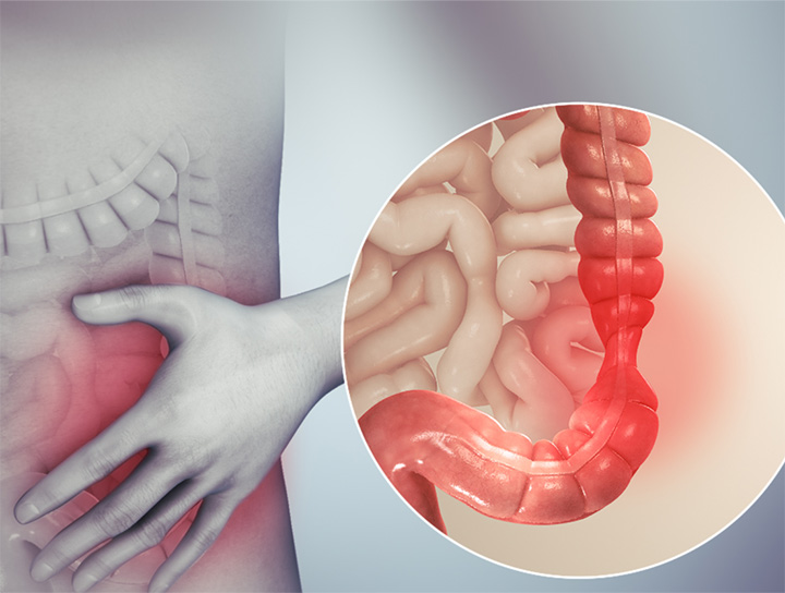 illustration of the makeup of the bowels and how irritation happens