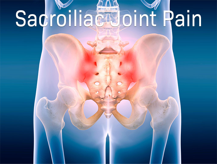 illustration of the makeup of sacroiliac joint pain